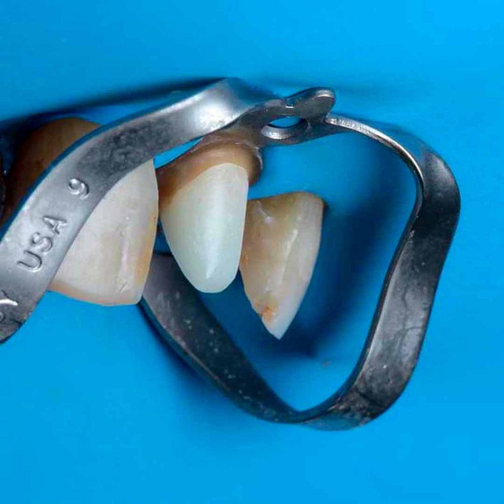 aislamiento para retratamiento de endodoncia