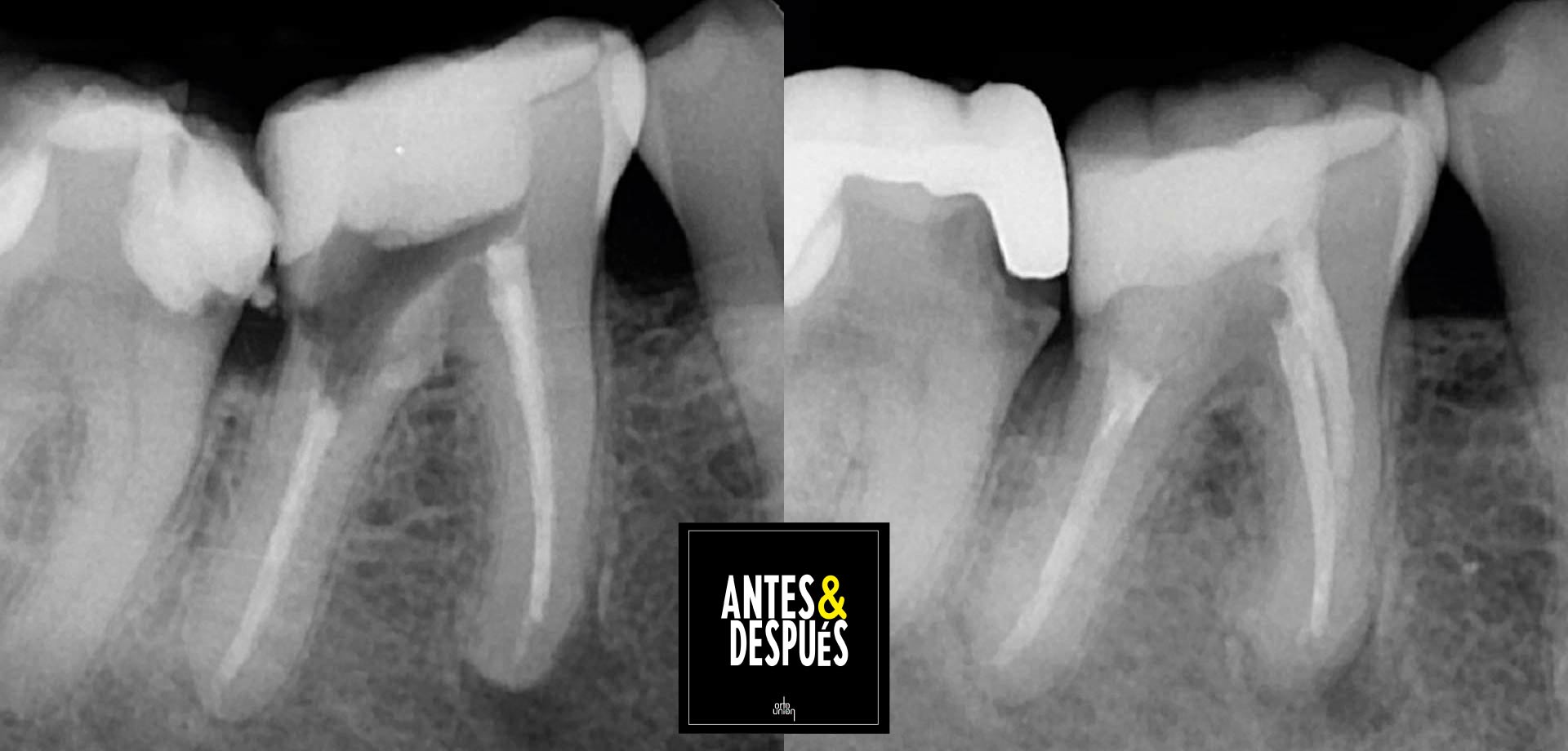 retratamiento de conductos endodoncia