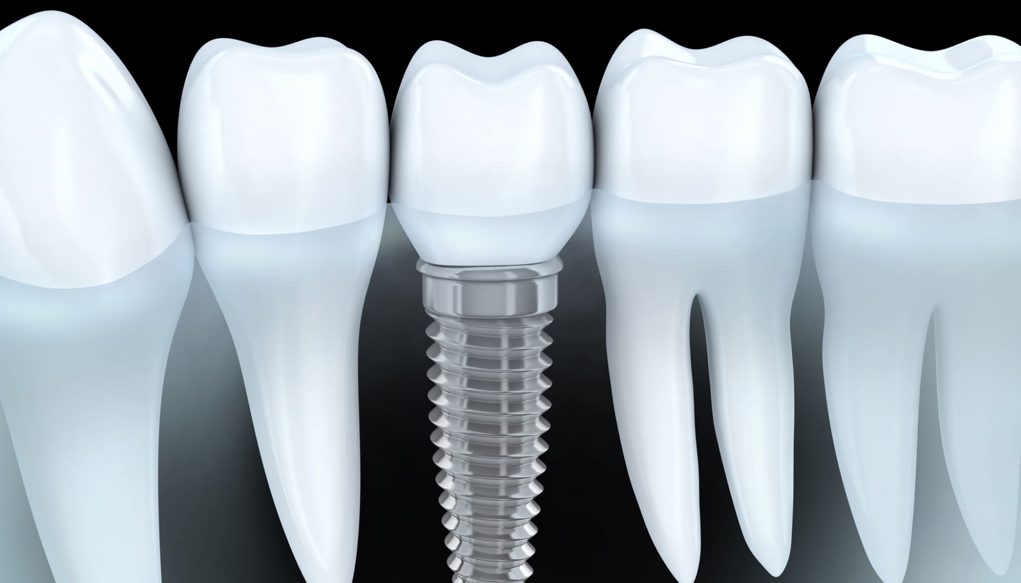 implantes dentales Medellín