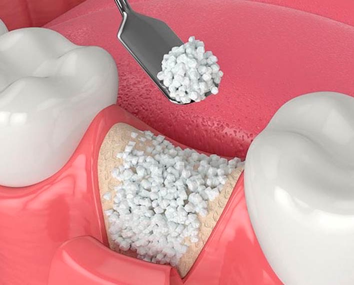 Injerto Óseo para Implante Dental