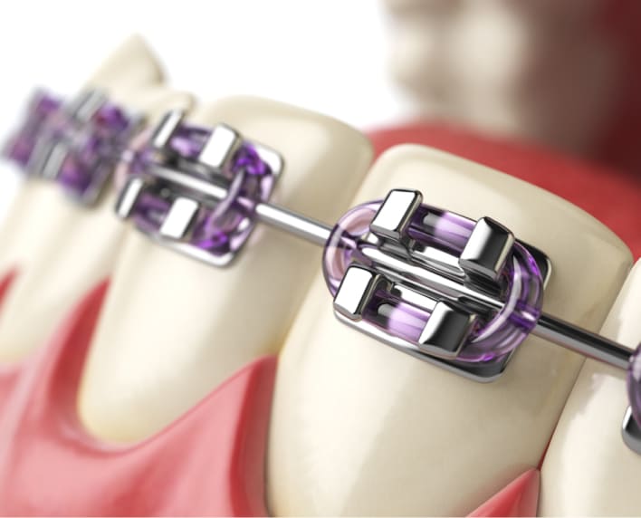 brackets metálicos