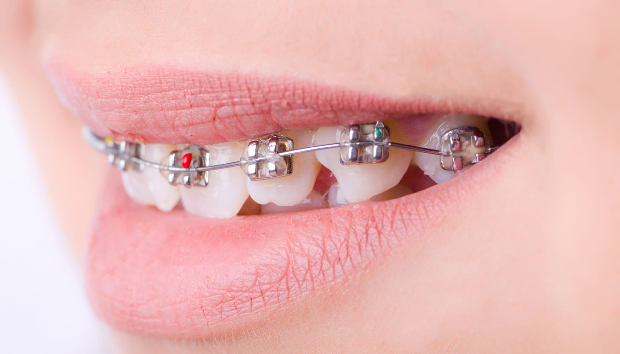 Ortodoncia en medellín
