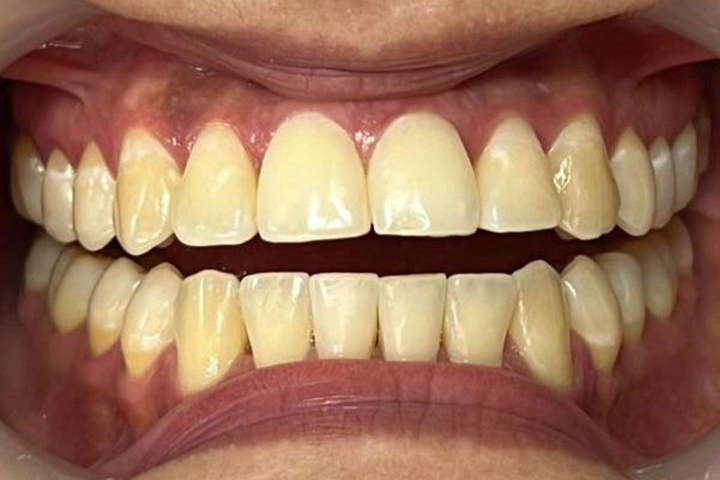 diseño de sonrisa blanqueamiento dental