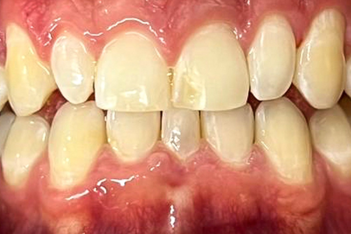 diseño de sonrisa carillas dentales