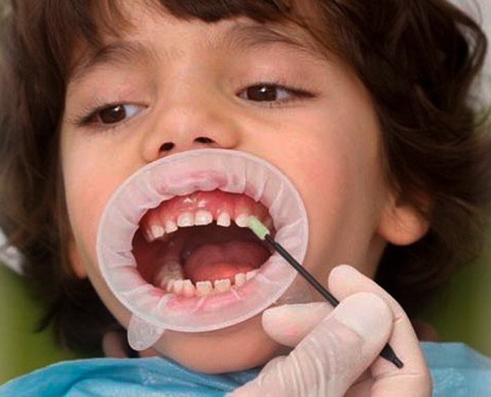 aplicacion de barniz de fluor