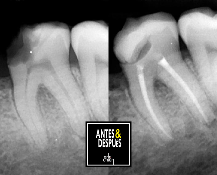 endodoncia birradicular antes y después
