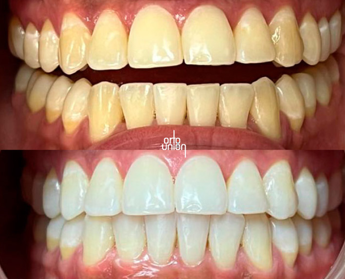 blanqueamiento dental Medellín