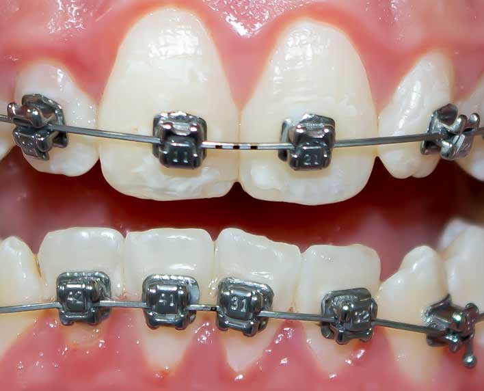 brackets autoligado metalicos