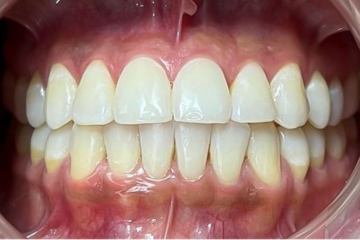 diseño de sonrisa blanqueamiento dental