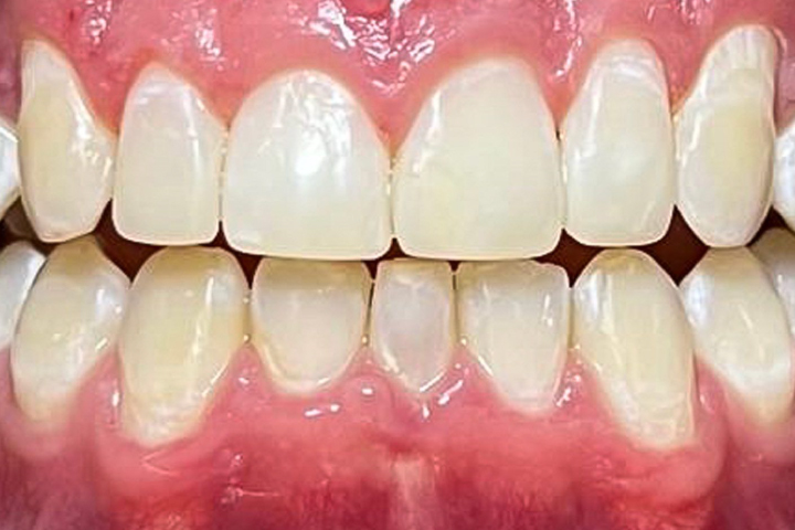 diseño de sonrisa carillas dentales