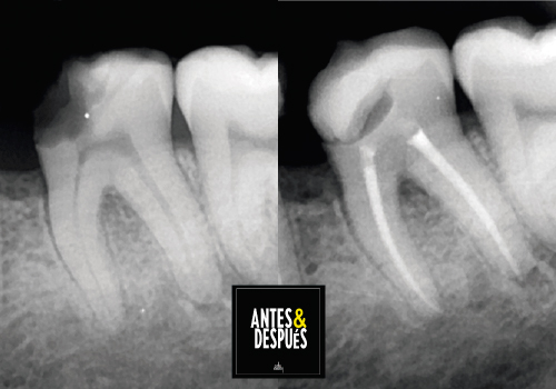 endodoncia de diente birradicular antes y después vista radiográfica