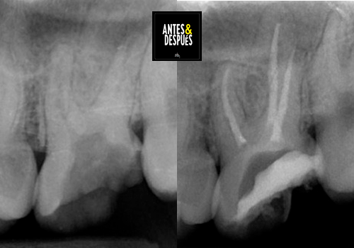 endodoncia de diente multirradicular antes y después vista radiográfica