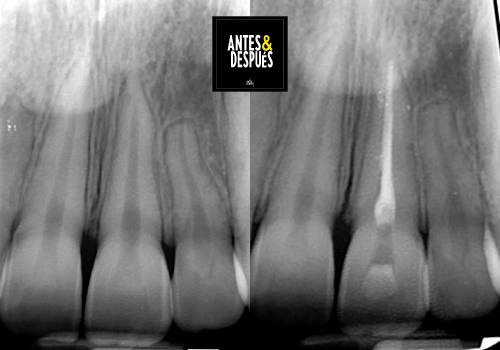 endodoncia de diente unirradicular antes y después vista radiografica