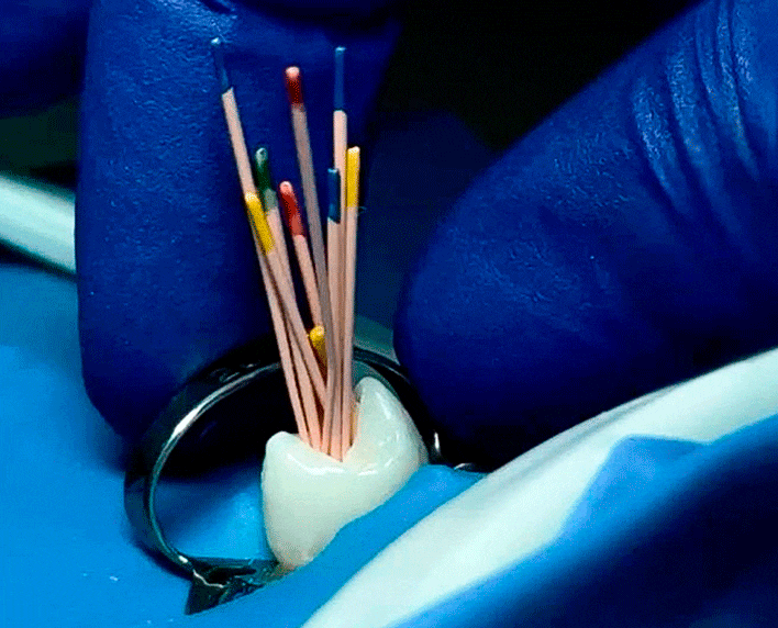 endodoncia y tratamiento de conductos en medellin