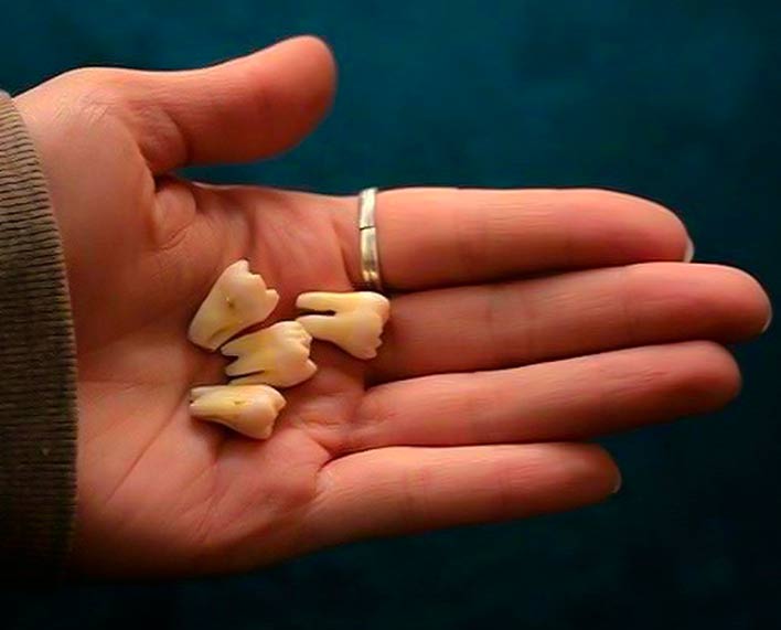 extracción de cordales