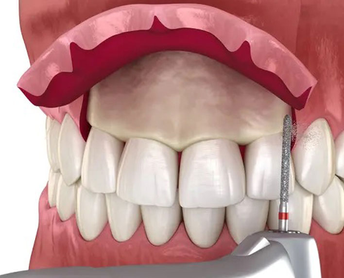 gingivectomía
