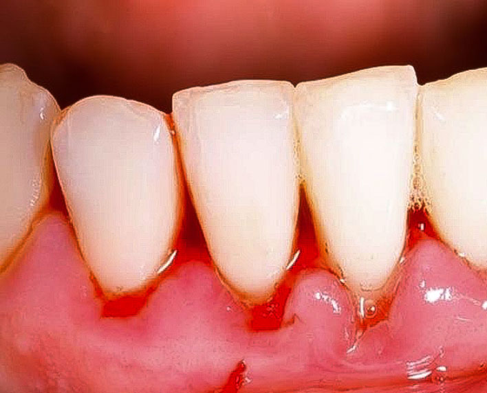 gingivitis y periodontitis