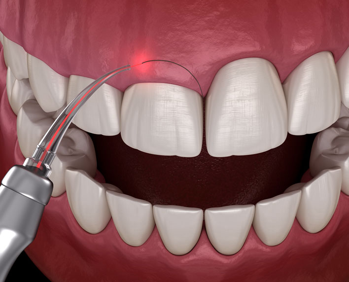 gingivoplastia estetica