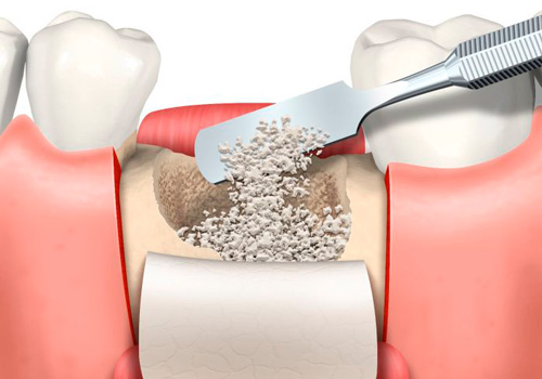 injerto óseo para implantes dentales