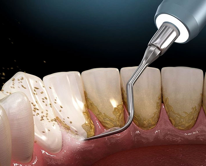 profilaxis dental
