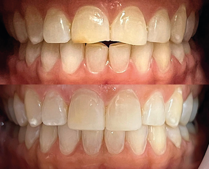 micro diseño de sonrisa