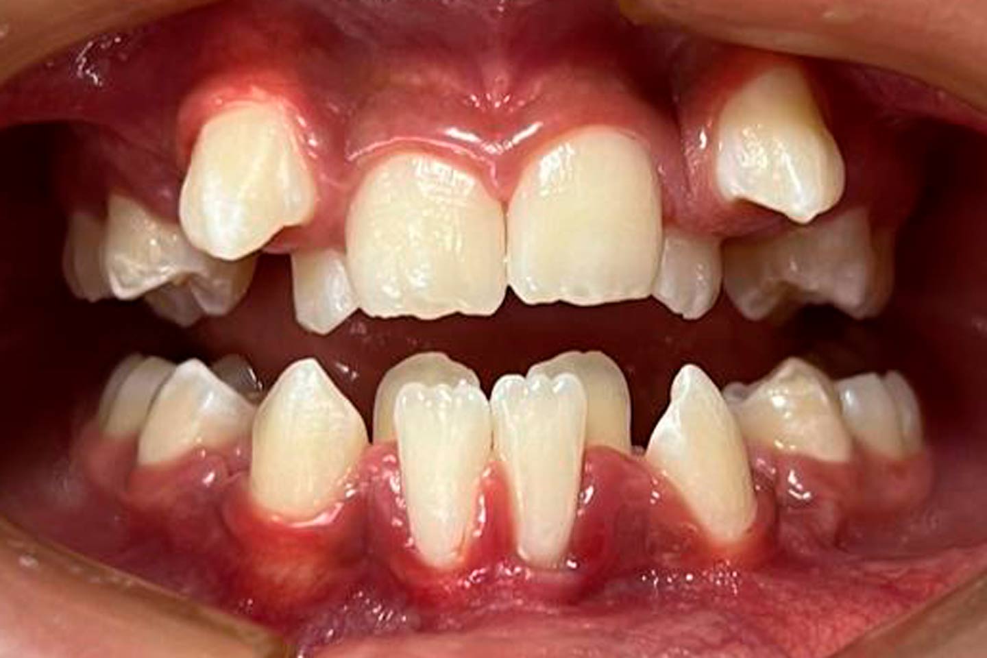 Vista frontal de los dientes antes del tratamiento de Ortodoncia