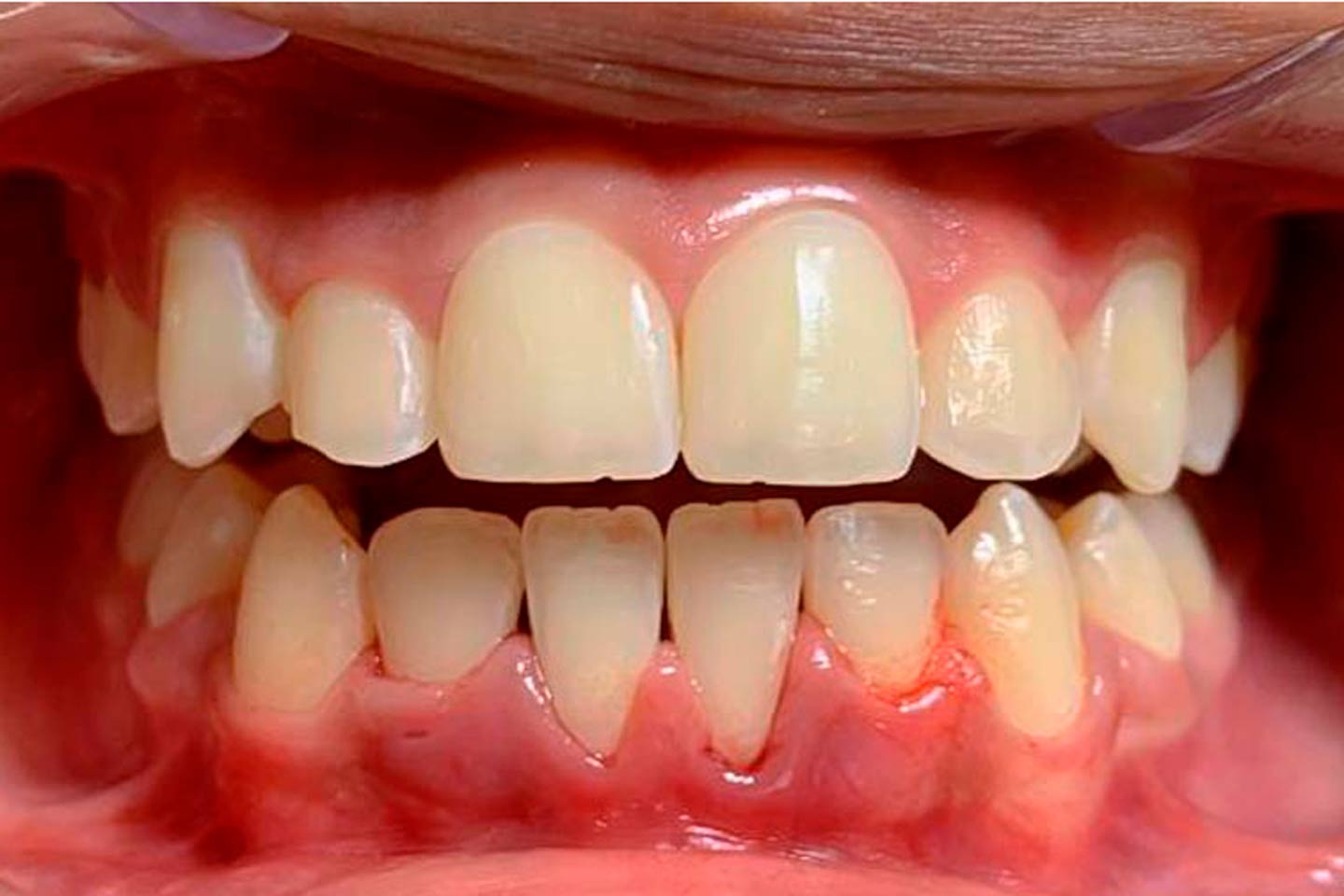 Vista frontal de los dientes después del tratamiento de Ortodoncia