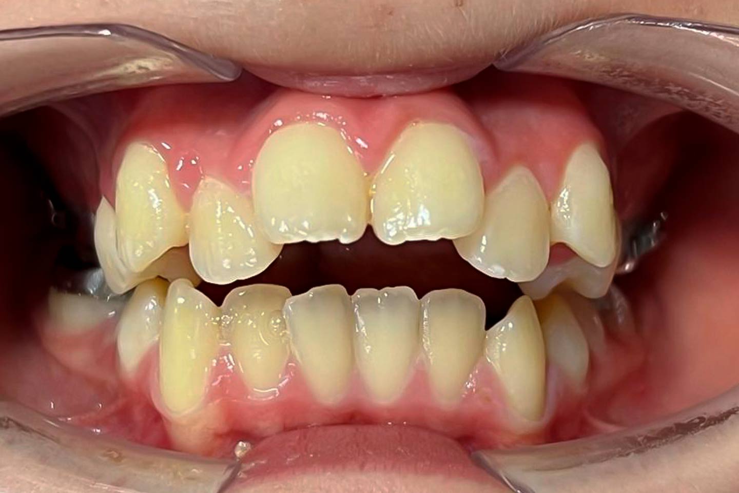 Vista frontal de los dientes antes del tratamiento de Ortodoncia