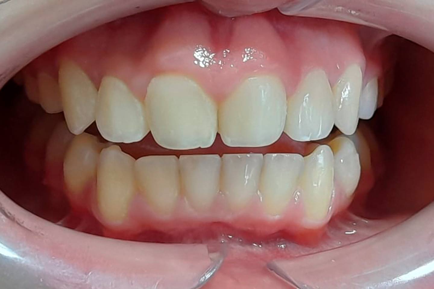 Vista frontal de los dientes después del tratamiento de Ortodoncia
