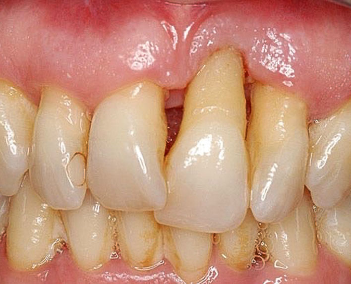 gingivitis y periodontitis