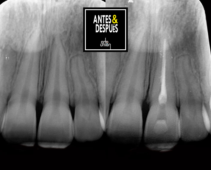 endodoncia unirradicular antes y después