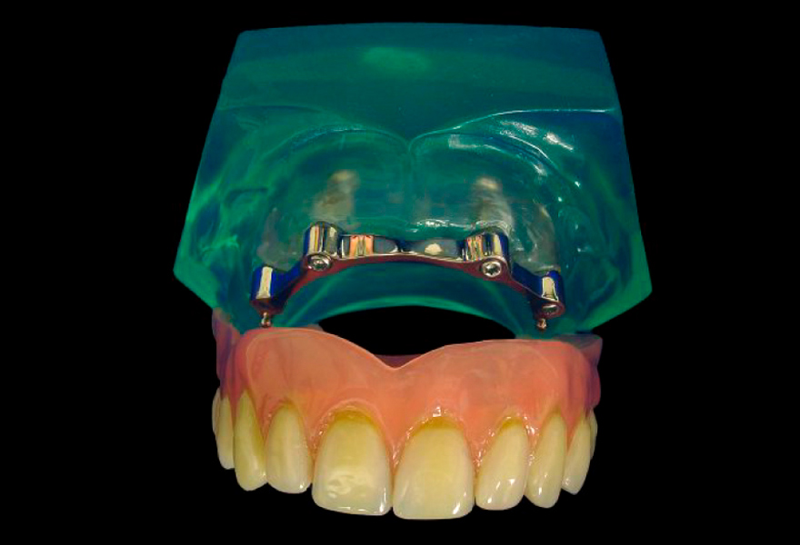 protesis sobredentadura retenida con barras sobre implantes