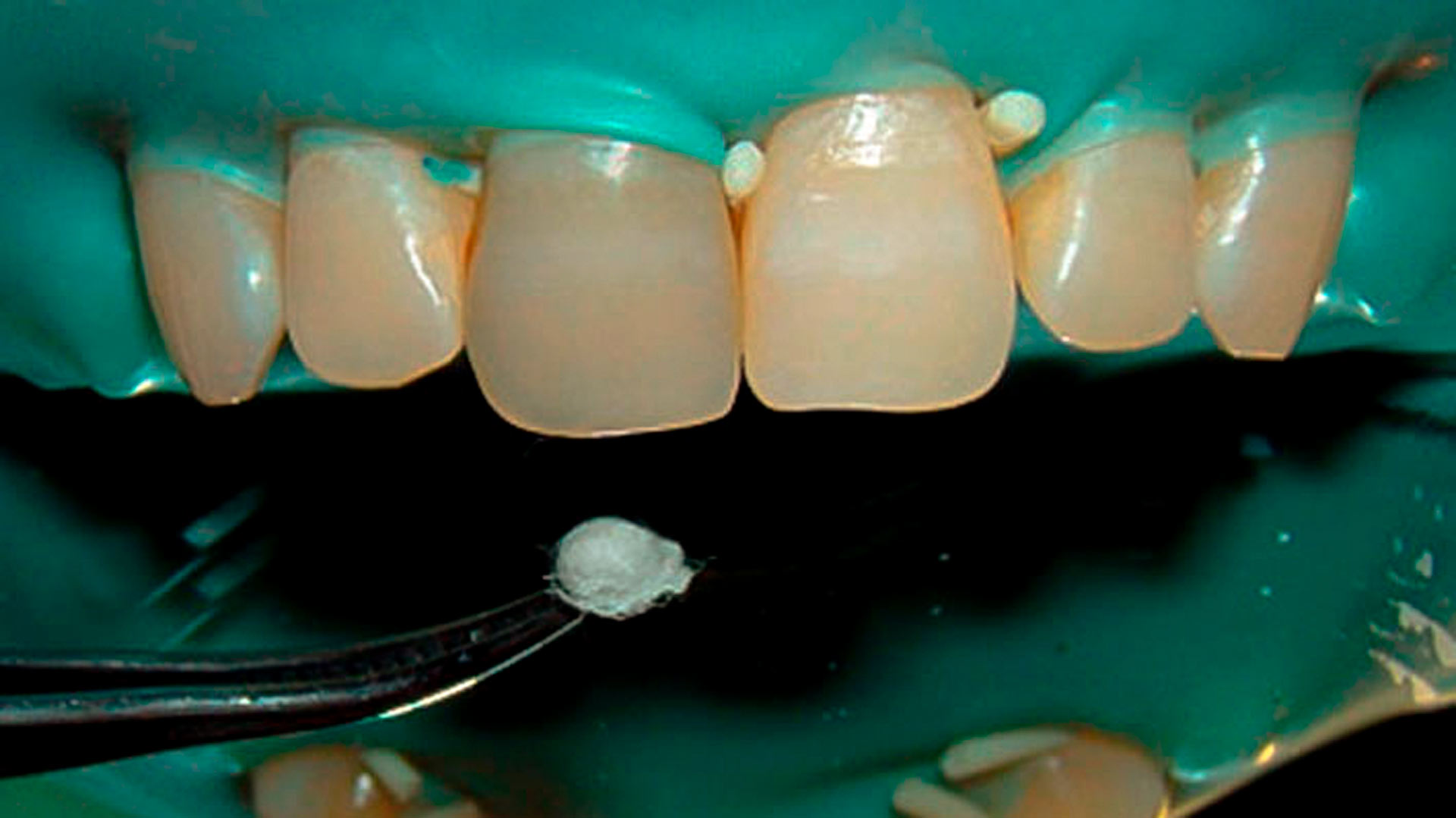 blanqueamiento de diente no vital
