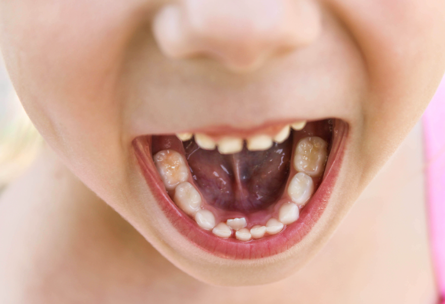 caries en los niños