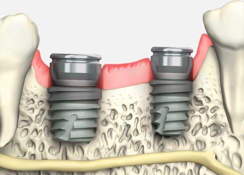 colocacion de implante dental