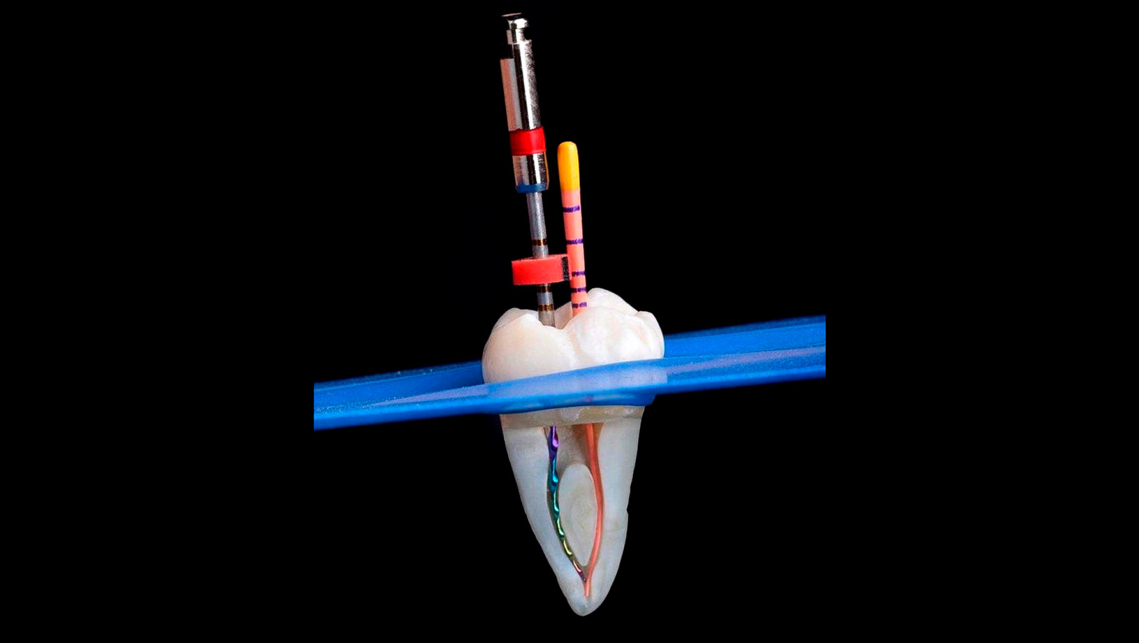 como se realiza una endodoncia