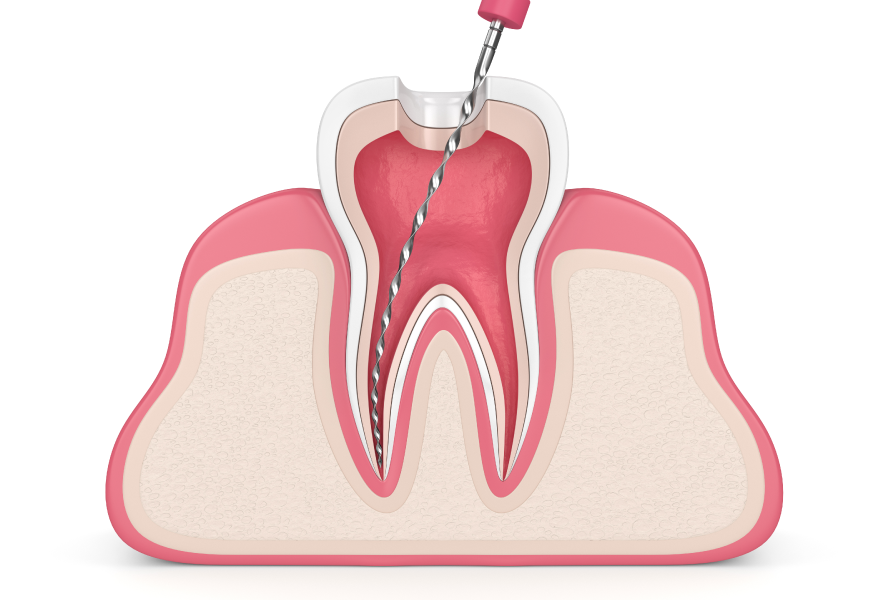 cómo se realiza una endodoncia