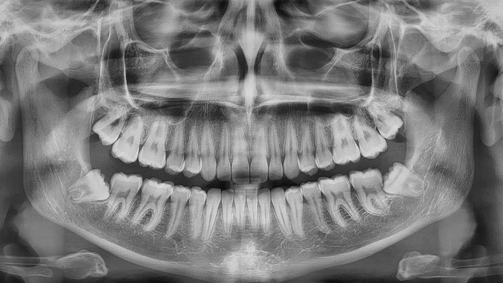 las cordales tuercen los dientes