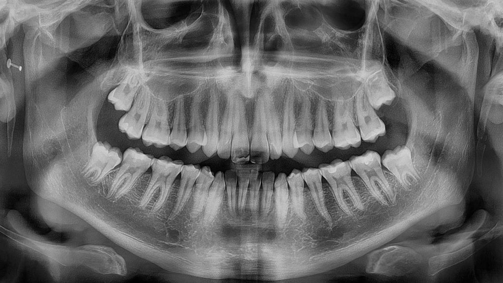 las cordales tuercen los dientes