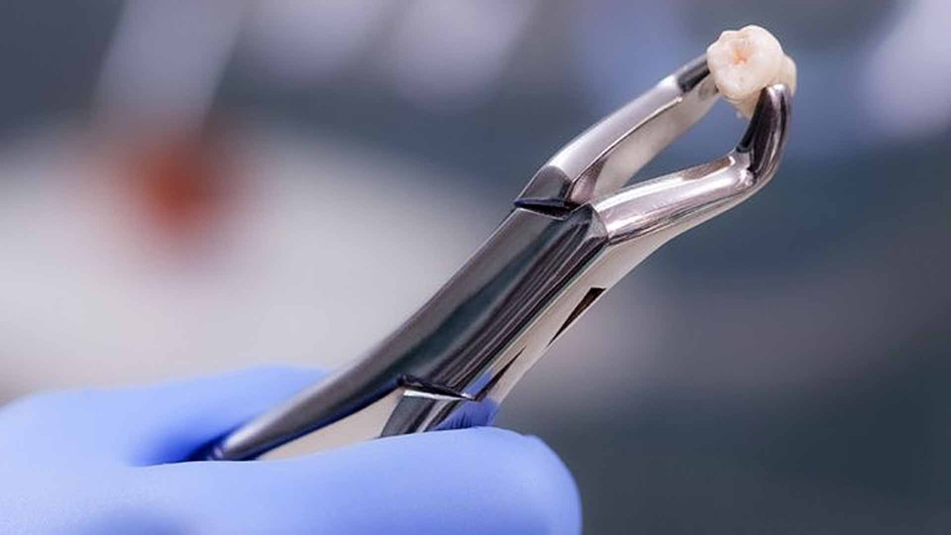 cuidados despues de una extraccion dental