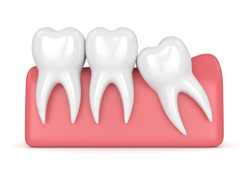 Las cordales tuercen los dientes