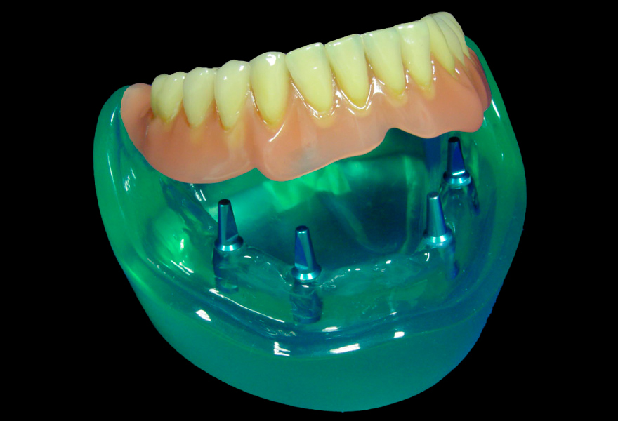 protesis sobredentadura con locators