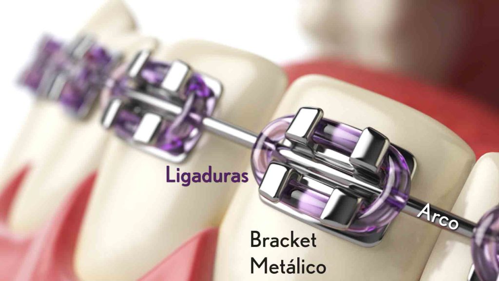 elementos brackets metalicos