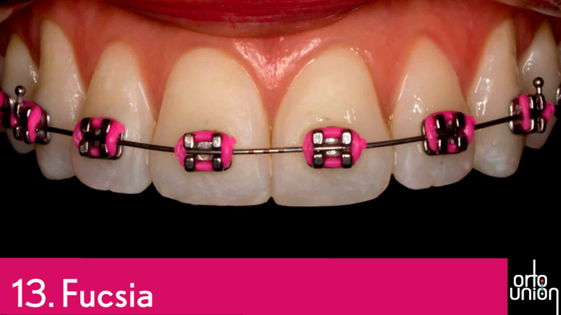 cauchos color fucsia para brackets