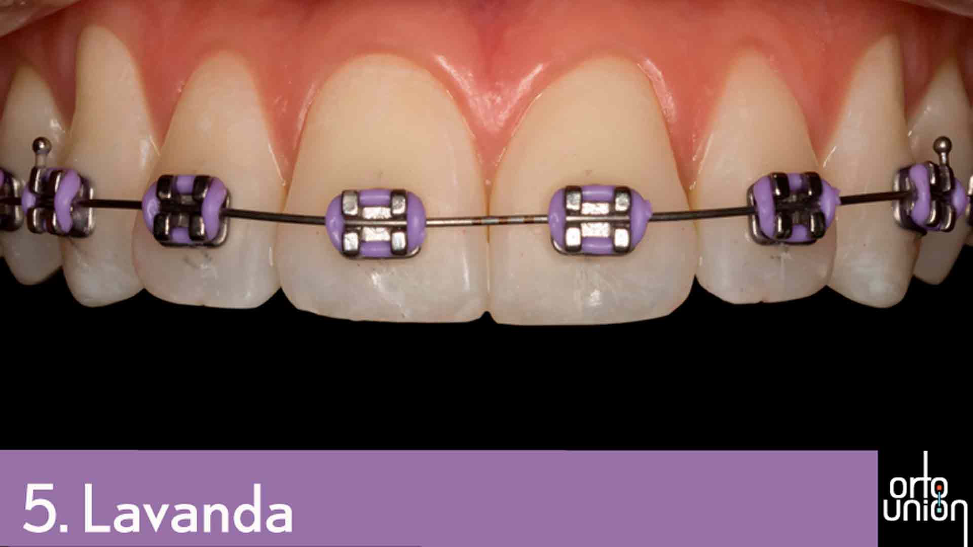 cauchos color lavanda para brackets