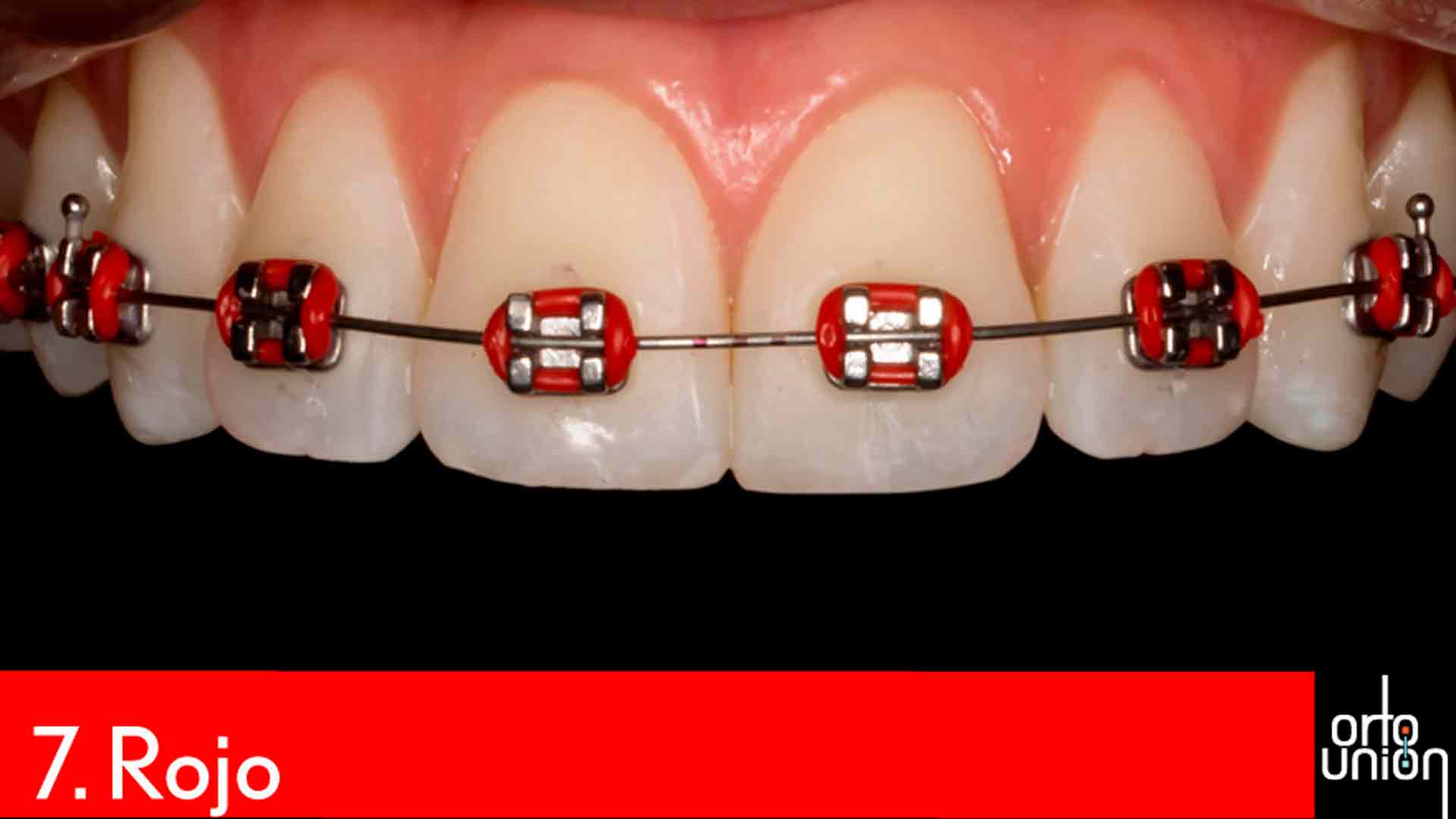 cauchos color rojo para brackets