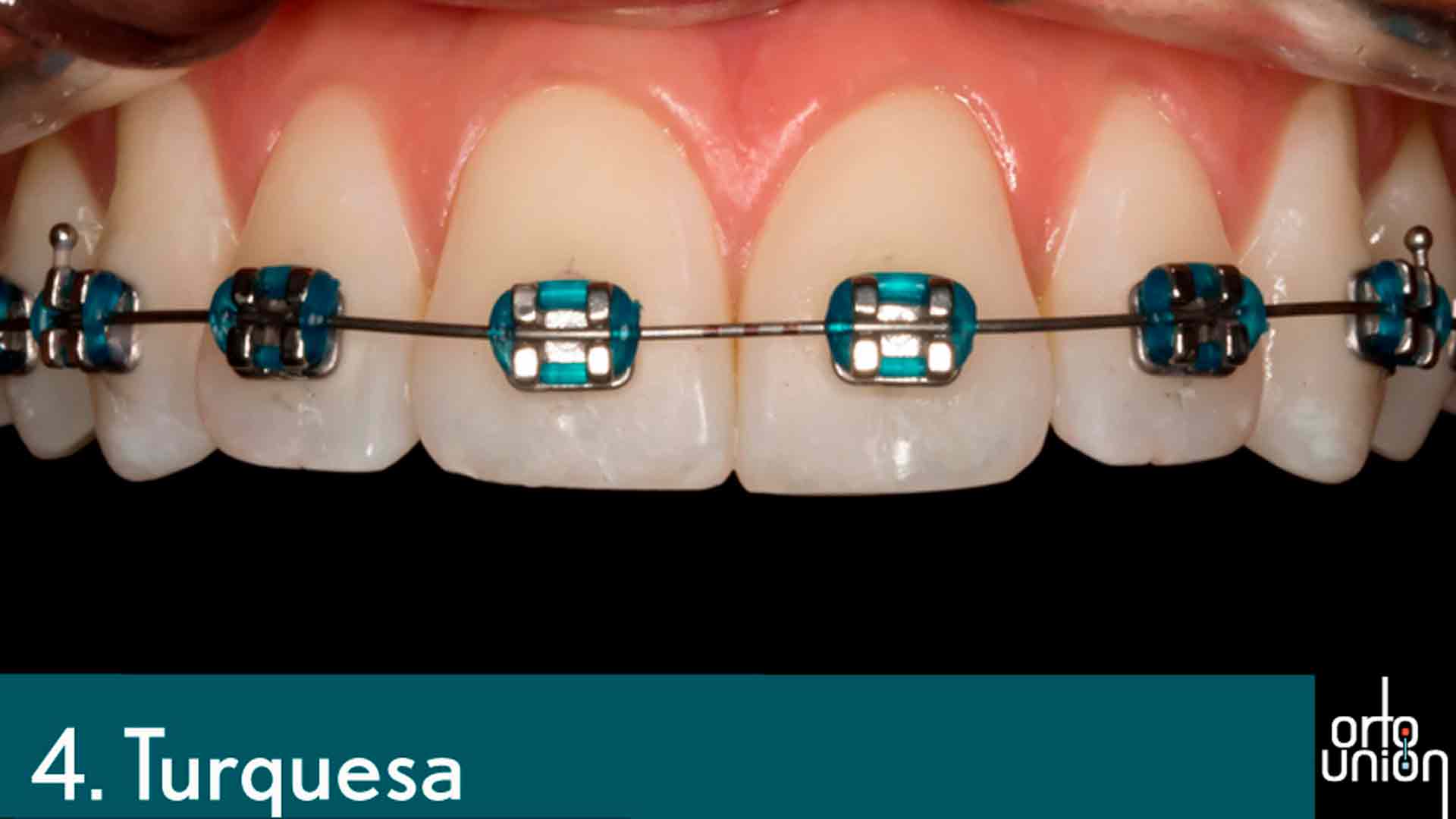 cauchos color turquesa para brackets