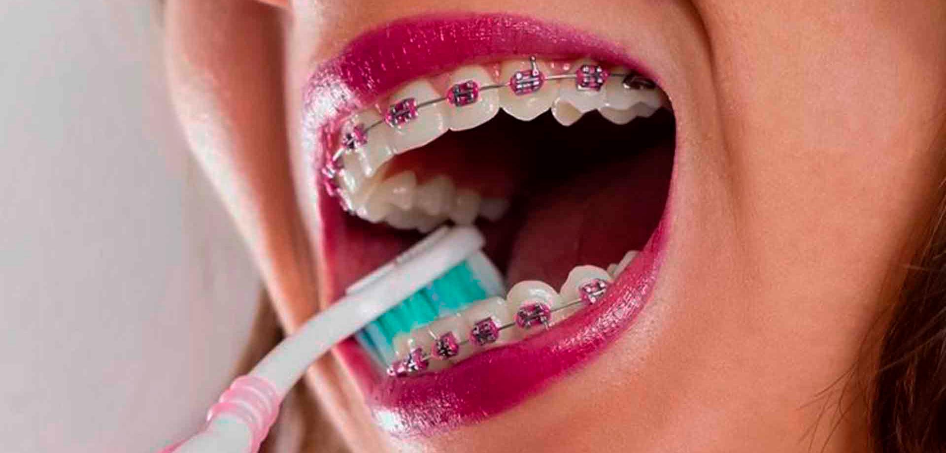 como cepillarse los dientes con brackets
