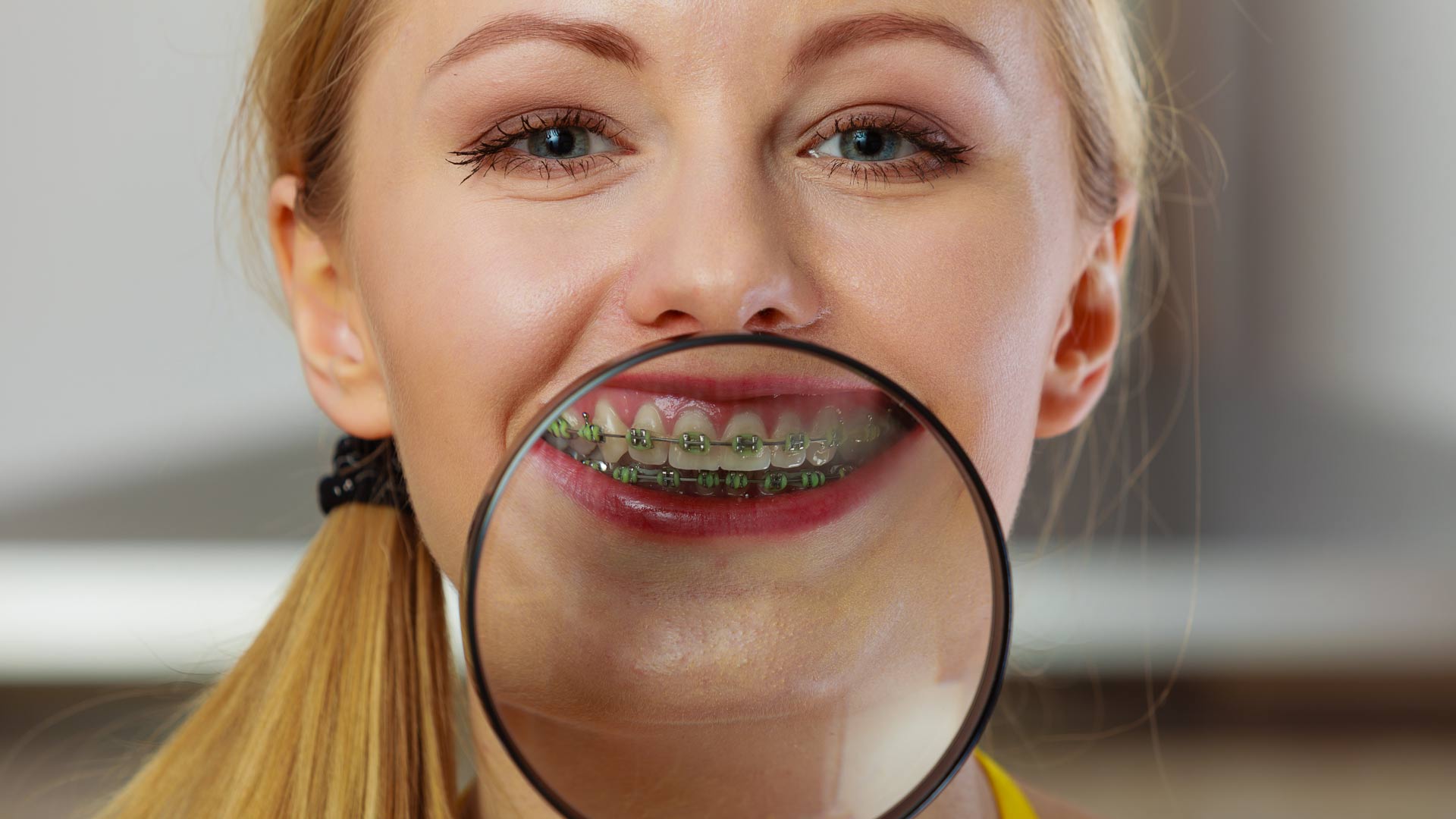 precio de los brackets en colombia