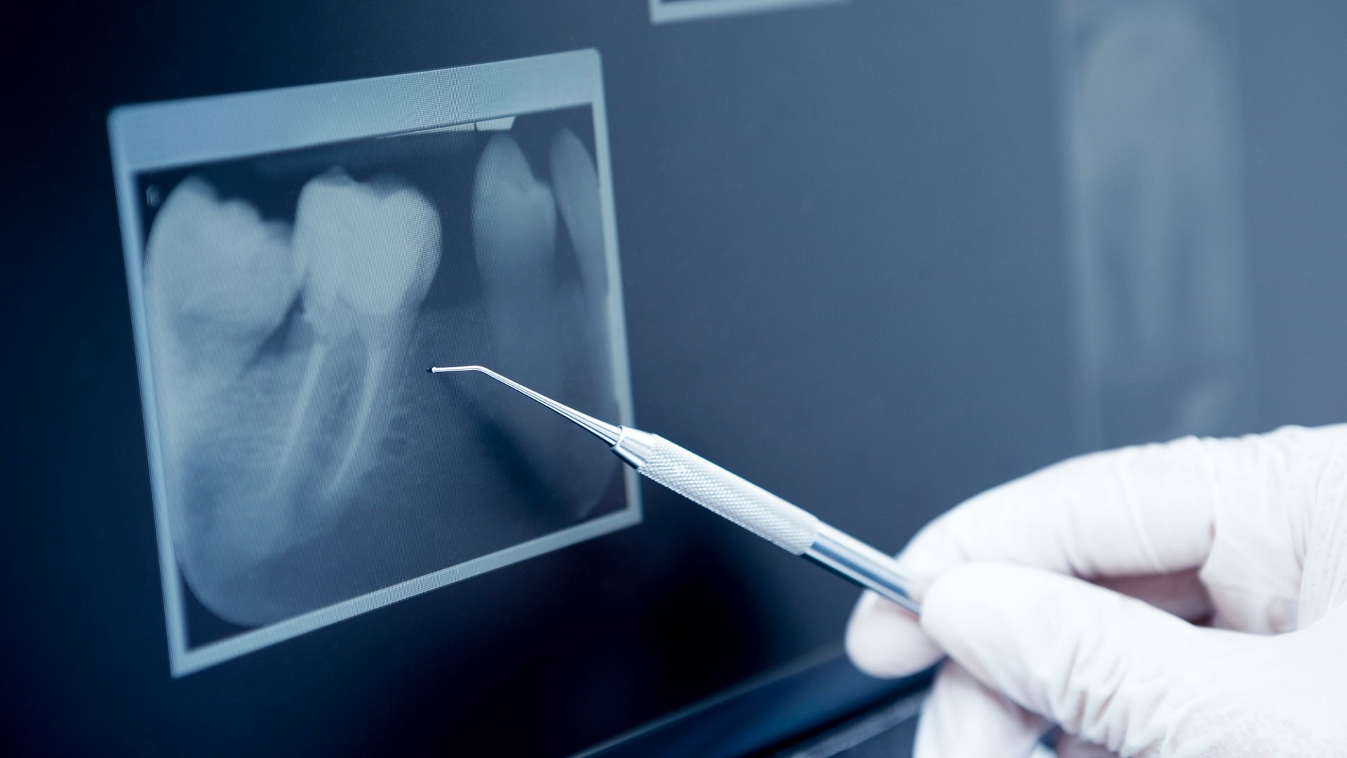 precio de una endodoncia